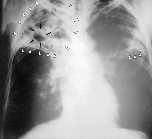 NApredovala tuberkuloza